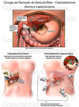Colecistectomia (Cirurgia da Vesícula Biliar)