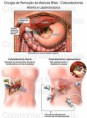 Colecistectomia (Cirurgia da Vesícula Biliar)