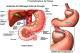 Cirurgia do Refluxo